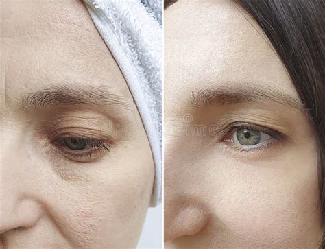 Woman Face Wrinkles Regeneration Aging Dermatology Lifting Before And