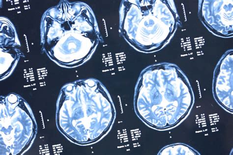 Jun 05, 2016 · die am häufigsten assoziierte krankheit ist die exzitose, ein vorgang, bei dem die neuronen durch eine überaktivierung stark geschädigt oder zerstört werden. Die tödliche Huntington-Krankheit beginnt schon in der ...