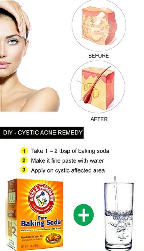 Here Are 15 Diy Hacks Tips And Tricks That Will Make That Acne Vanish