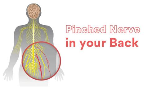 A Pinched Nerve May Be Causing Your Back Pain An Tâm