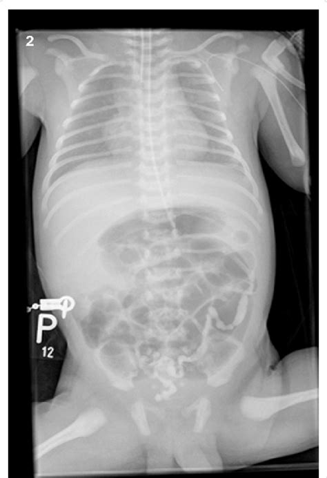 A Projection From The Abdominal X Ray Performed After The Patients