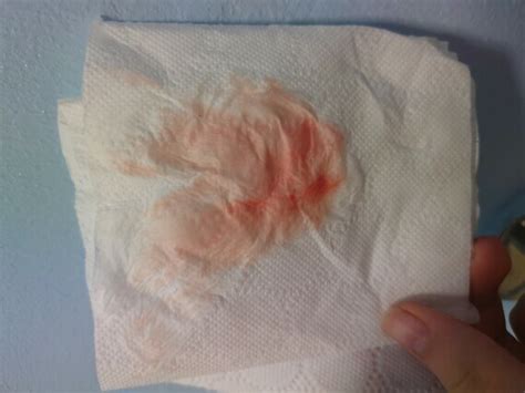Implantation Bleeding Tmi Photos