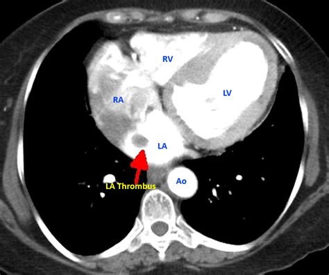 Left Atrial Thrombus Contrast Ct Scan All About Cardiovascular