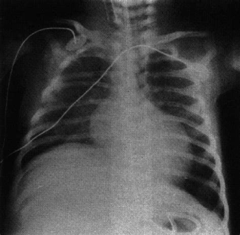 Chest-X-ray-showing-raised-showing-raised-hemidiaphragm-on ...