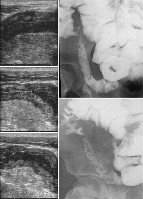 Oral Contrast Enhanced Bowel Ultrasonography In The Assessment Of Small