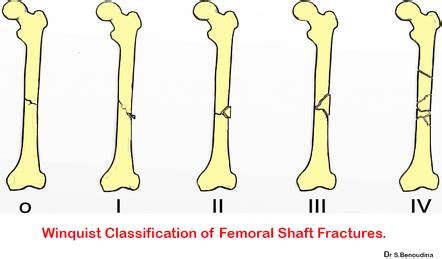 Winquist Classification Of Femoral Shaft Fractures Radiology My Xxx