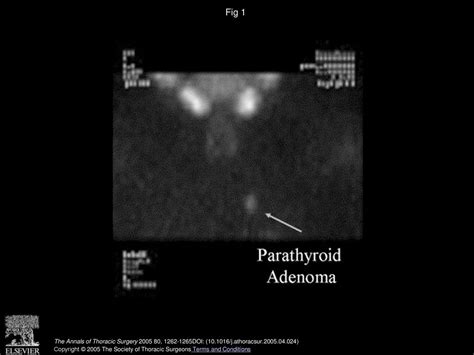 Radioguided Thoracoscopic Mediastinal Parathyroidectomy With