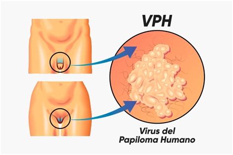 Examenes de laboratorio para detección del VPH Precio de muestra