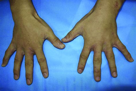 Erythematous Papules On His Dorsum Of Hands And Finger Web Spaces