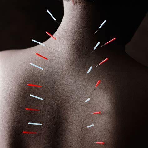 Do We Finally Understand How Acupuncture Works