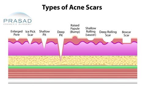 Acne Scars Treatment Prasad Cosmetic Surgery Nyc