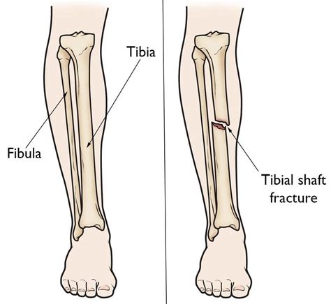 Tibial Shaft Fracture Causes Types Symptoms Diagnosis Treatment Prognosis