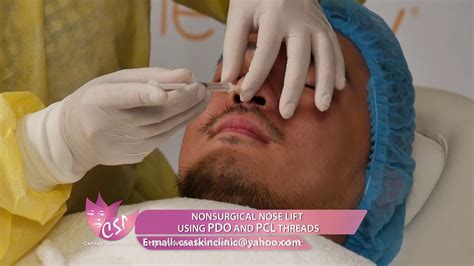 Nonsurgical Nose Lift Using Pdo And Pcl Threads For Men Youtube