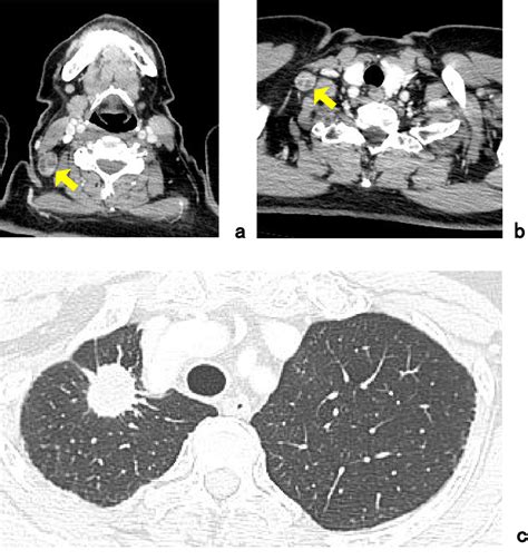 Figure 1 From A Case Of Lung Cancer With Cervical Lymph Node