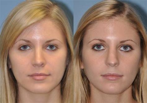 Before And After Pictures Plastic Surgery Chevy Chase