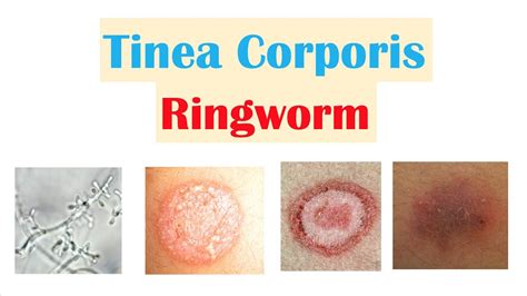 Ringworm Stages