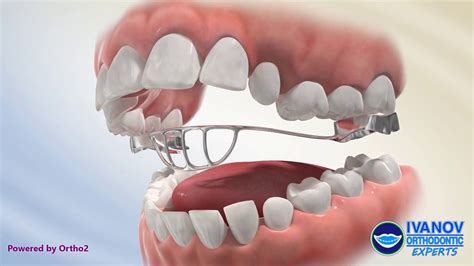 tongue thrust treatment for adults jacobos mezquita