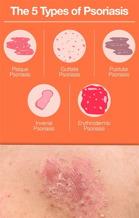 What Is Psoriasis Learn About Causes Symptoms Treatments The Amino