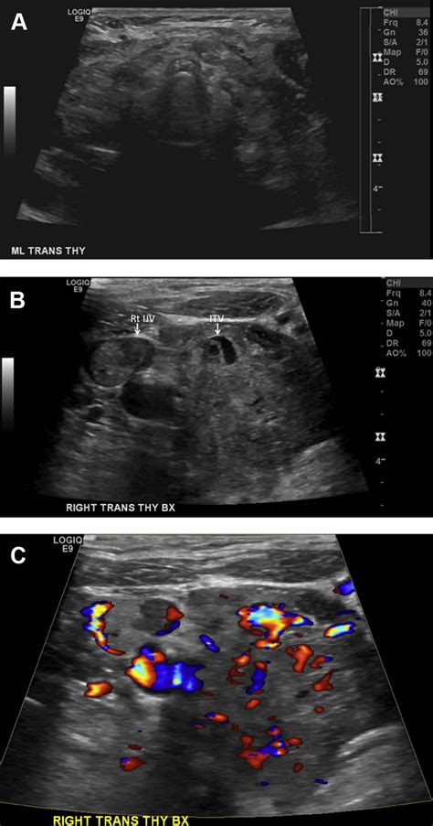 E A Transverse Ultrasound Image Of The Thyroid Demonstrates An