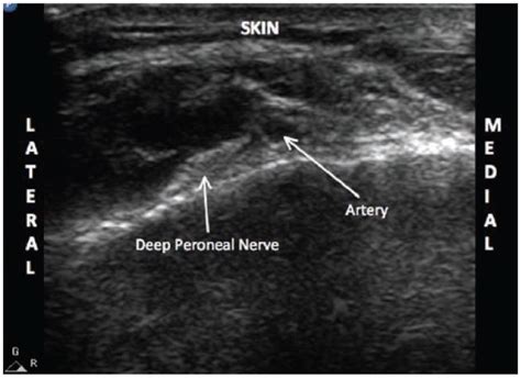 Ultrasound Image Of The Deep Peroneal Nerve In The Ankle The Dorsalis