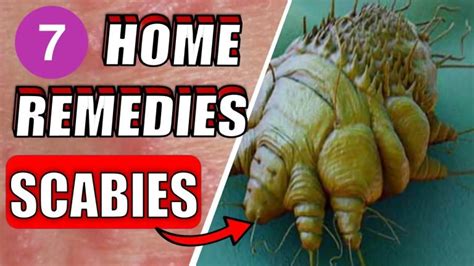 7 Effective Scabies Home Natural Treatments Epic Natural Health