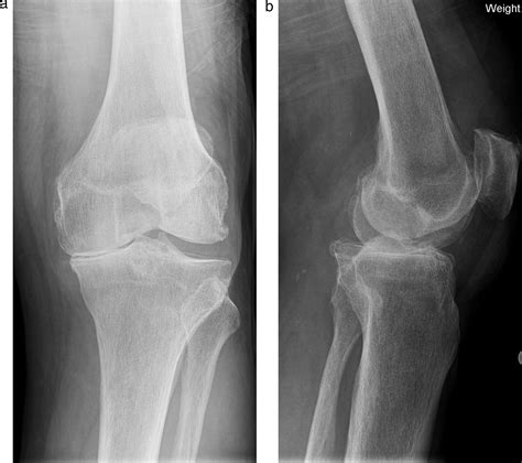 Knee Replacement For Osteoarthritis Maturitas