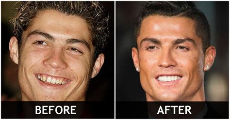 Before And After Pictures Of Celebrities Who Have Had Their Teeth Done