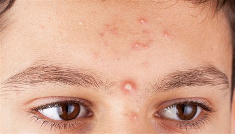 Pimple On Eyebrow Learn How To Get Rid Of Acne Between Eyebrows