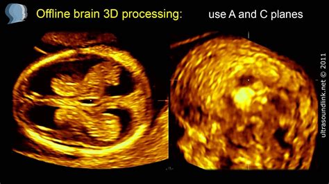 3d Scan Of The Fetal Brain At 11 13 Weeks Gestation Youtube