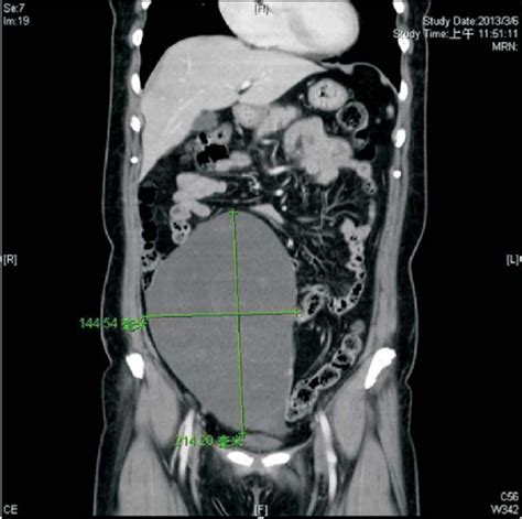 Contrast Enhanced Computed Tomography Scan Reveals A 214 ´ 144 Cm