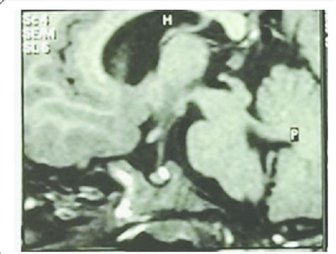 Mri Of The Brain Showing Slightly Enlarged Ventricles And Pituitary
