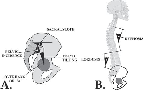 The Sagittal Pelvic And Spinal Parameters Download Scientific Diagram