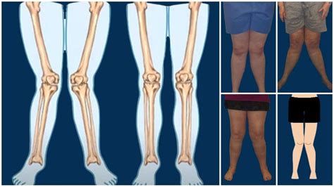 Knock Knee Deformity Causes Symptoms Diagnosis And Treatment