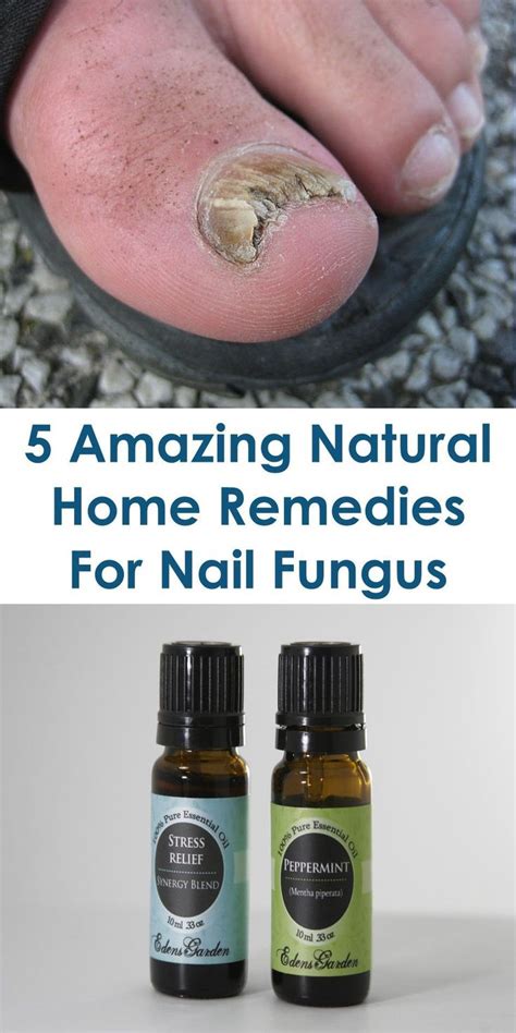 11 Astonishing Home Remedies For Toenail Fungus That Really Work Ideas