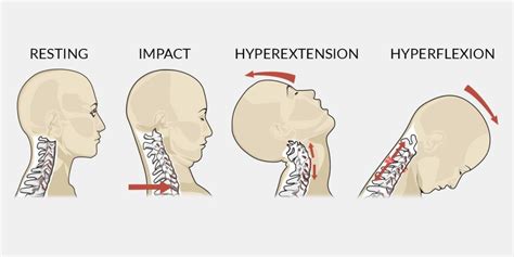 Whiplash Associated Disorder W Ad Archives Physiotherapists In