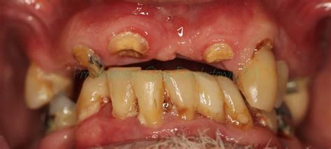 Saving And Restoring The Function And Smile Of Patients With Severe