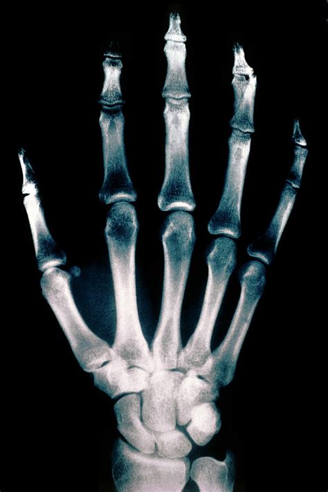 Colorvir X Ray Photo Of Normal Right Hand Photograph By Stammers