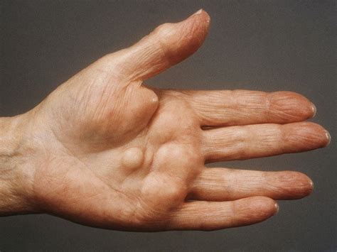 Tendon Inflammation In The Hand Predicts Future Arthritis