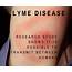 Dr Gabe Mirkin On Health Fitness And Nutrition  Lyme Disease May Be