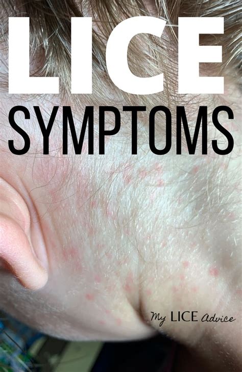 17 Lice Symptoms With Pictures Signs That You Have Head Lice In 2020 Head Louse Louse Lice