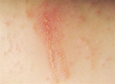 6 Tipos De Eczema Síntomas Y Causas