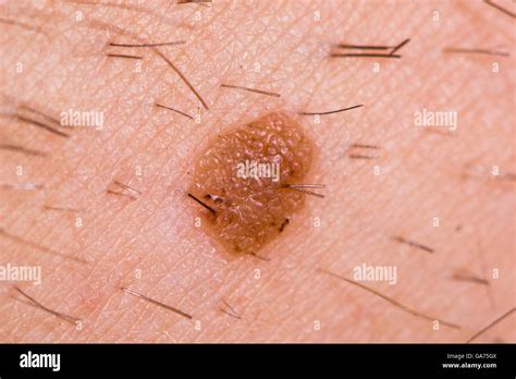 Benign Skin Lesion Fotos E Imágenes De Stock Alamy