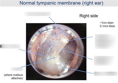 Normal Right Tympanic Membrane