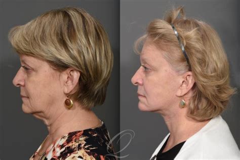 Brow Lift Before After Photo Gallery Serving Rochester Syracuse