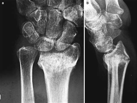 Distal Radius Malunion Musculoskeletal Key