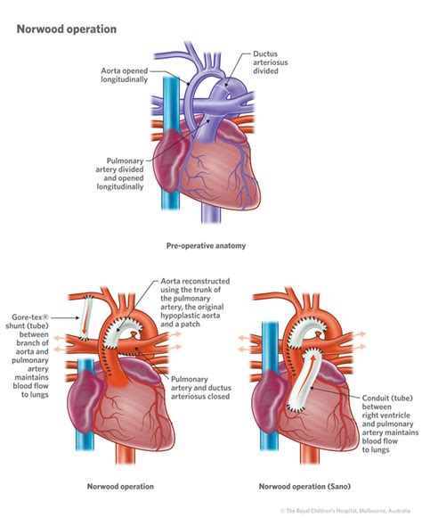 Cardiology Hypoplastic Left Heart Syndrome Hd