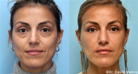 Before After Photos Of Non Surgical Facial Rejuvenation Contouring With