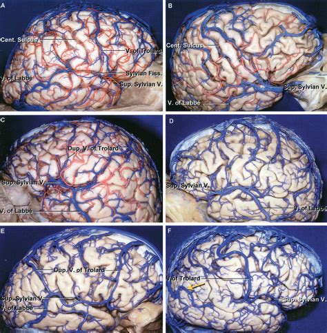 Cerebral Veins The Neurosurgical Atlas