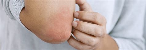 How To Treat Eczema On Elbows Eczema And More The Eczema Company