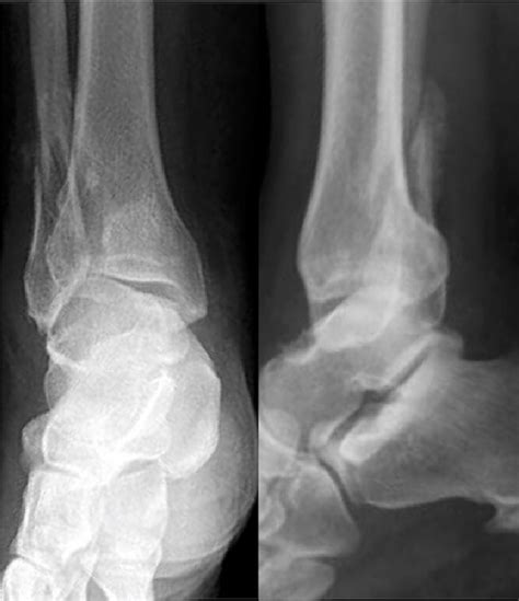Figure 1 From Treatment Of Distal Fibular Malunion With Corrective